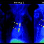 PET Tracer to Directly Detect Blood Clots