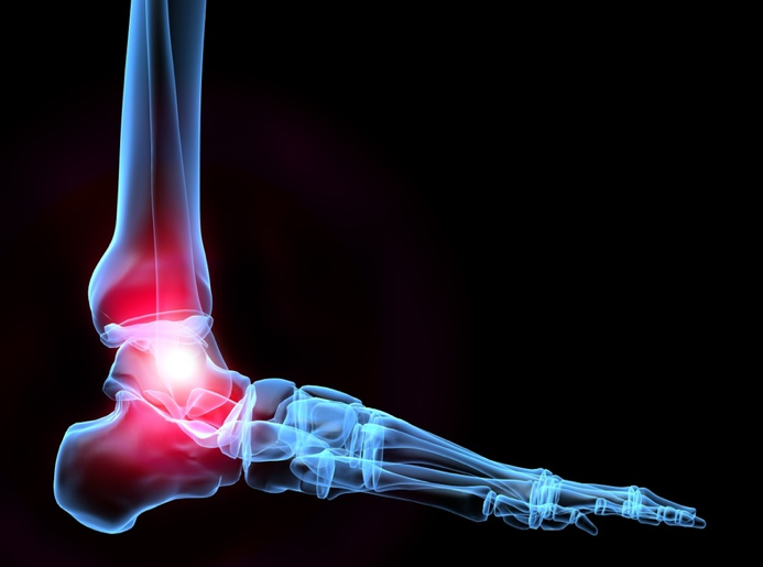 Ankle Arthritis Treatment Total Ankle Replacement Surgery The