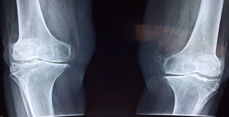 Total joint replacement – should I start with this?
