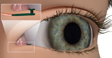 Glaucoma Therapeutics Market Demand, Developments, Industry Opportunities and Industry Research Report