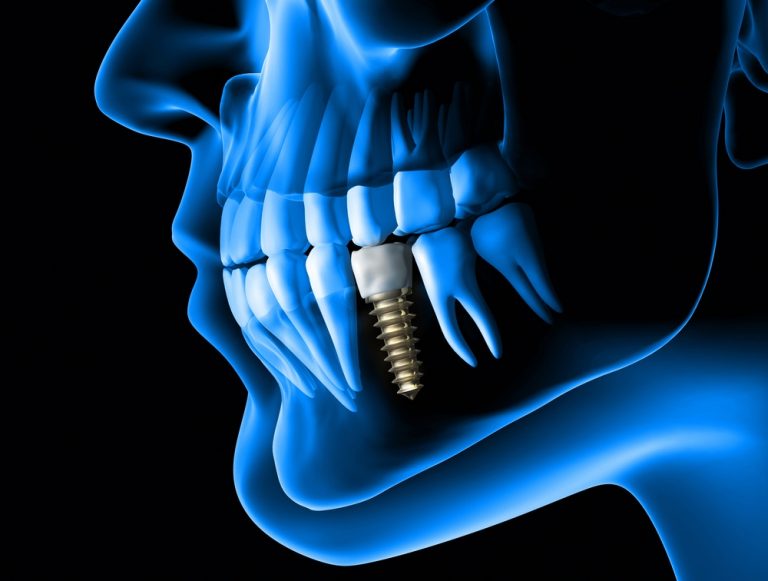 Technological Advancements In Dental Implant Surgery Syracuse NY