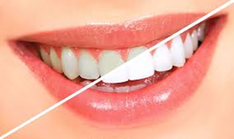 All You Need To Know About Teeth Whitening Procedures