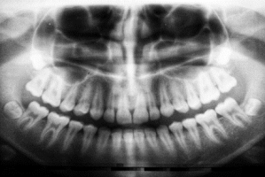 4 of the Rarest Diseases or Conditions that Can Affect Your Teeth | The ...