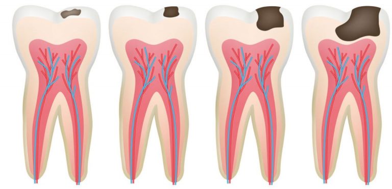 Dental caries