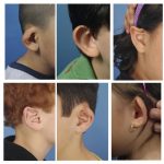 Ear molding