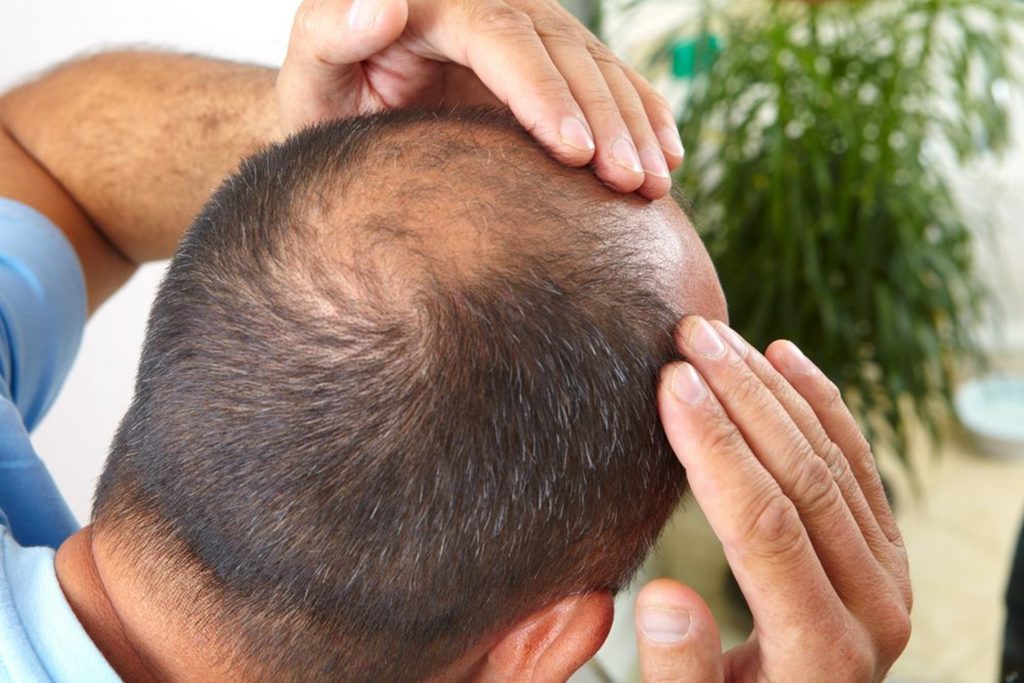 Things You Need To Know After Hair Transplantation Procedure The