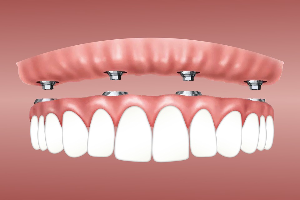 10 Worth Knowing Benefits of Dental Implants