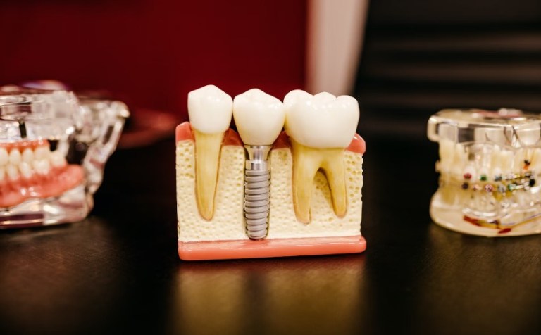 Immediate Loading Dental Implants: When Speed Meets Biological Risk