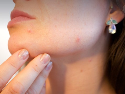 Finding The best treatment for hormonal acne For Your Teen