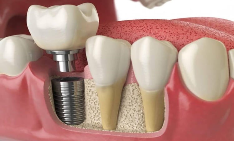 Dental Implants – Are They the Best Option For Your Missing Teeth?