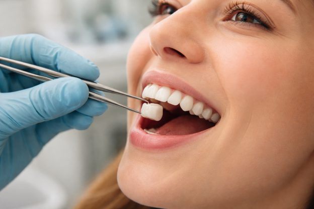 Understanding Ceramic Teeth Caps: A Natural-Looking Solution for Tooth Restoration