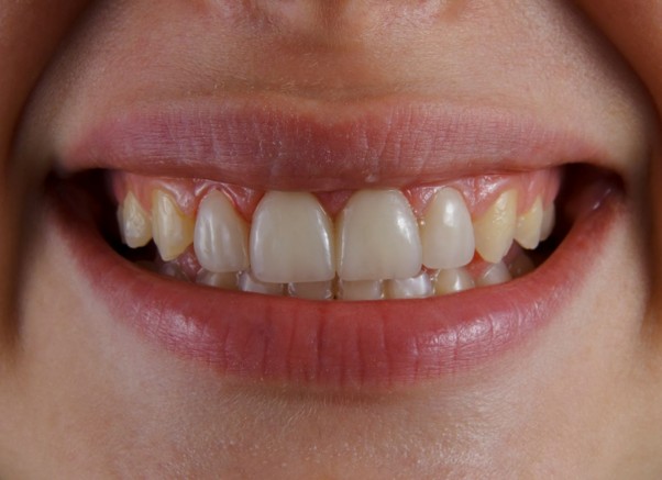 How Glasgow Dentists Are Transforming Smiles With Composite Bonding