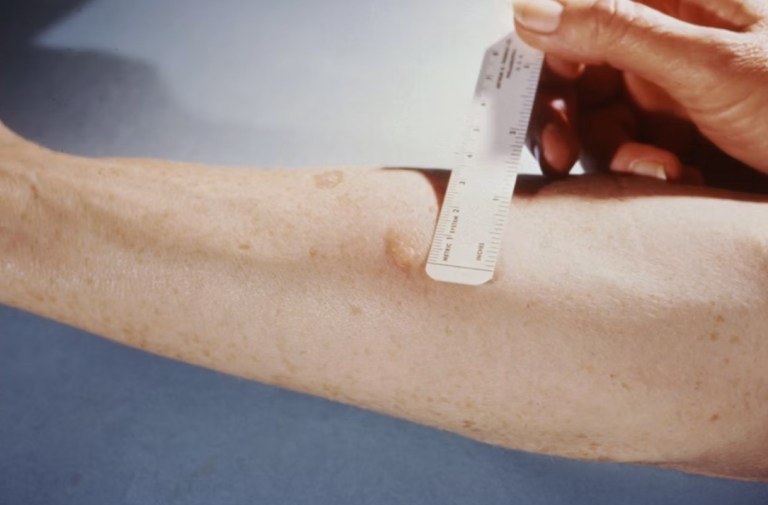 Why Chronic Venous Disease Deserves More Attention in Population Health Management