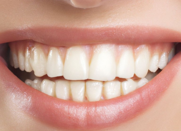 Here’s How Dental Implants Can Fix Your Smile