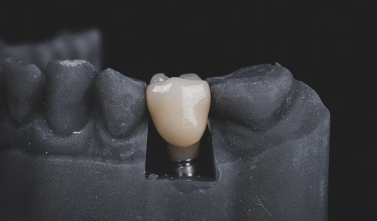 A Practical Guide to Tooth Loss, Restoration, and Long-Term Oral Health