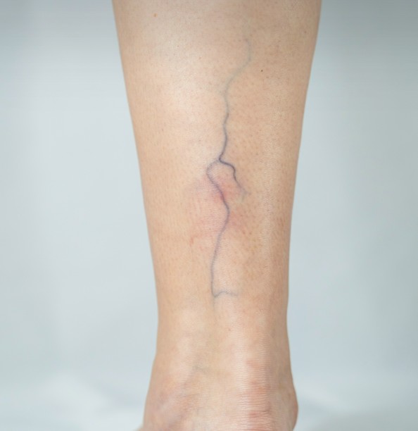 Common Symptoms of Varicose Veins That Should Not Be Ignored